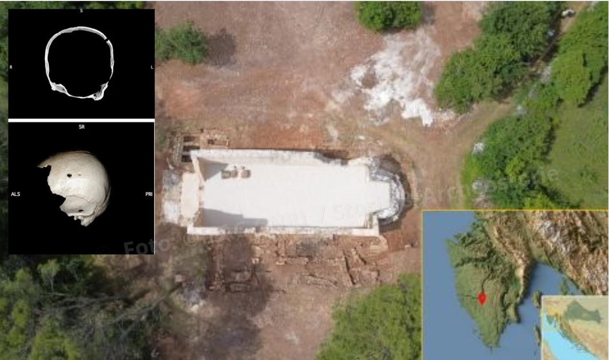 Ben quattro trapanazioni sullo stesso cranio: in Croazia un caso eccezionale di chirurgia medievale